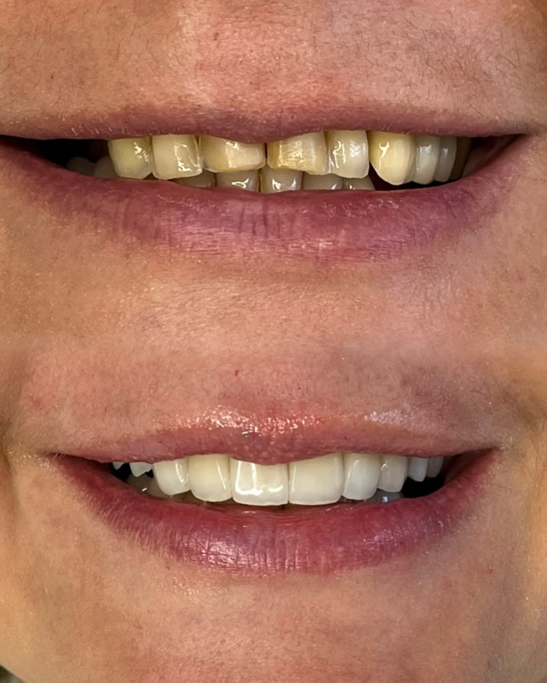 Coroas e Implantes